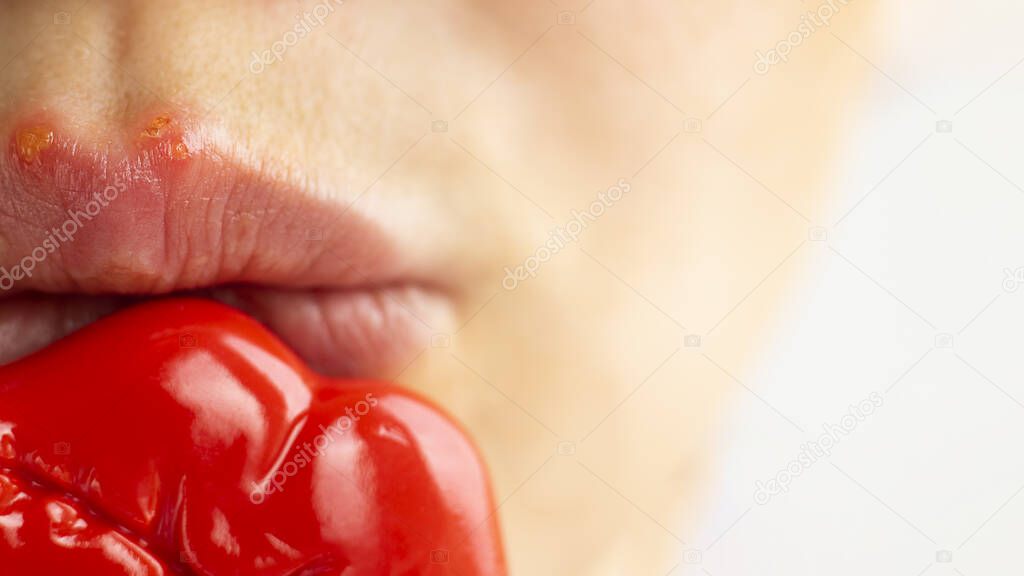 Part of a young woman face with red bubbles of virus herpes on lips that she tries to hide with toy lips for photo on patry. Medicine, treatment. horizontal selective focus, close up