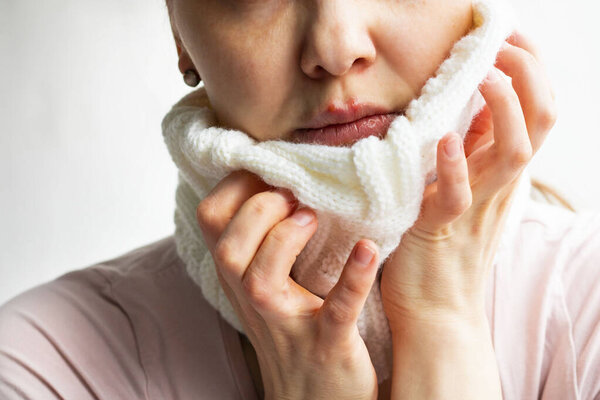Lower part part of woman face with Red bubbles of virus herpes on her lips, that she tries to hide under white knitted neckwarmer, Zoster, Cold, Medicine, Treatment. Horizontal, winter disease
