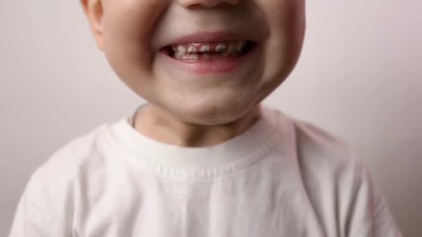 Close up shot of boy teeth. Health care, dental hygiene, dental problems, caries — Stock Video