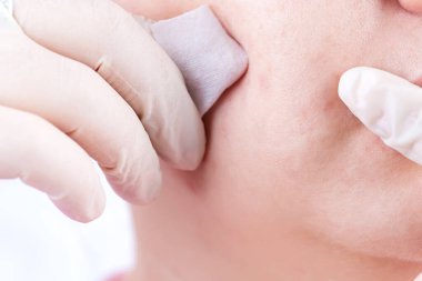 Cilt lekesi olan kadınlar ve temiz süngerli kauçuk eldivenli eller, cilt sorunlarına yakından bakan kadınlar..