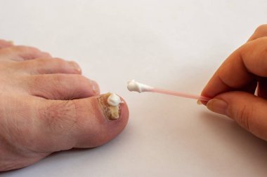 Kadın eli mantardan etkilenen ayak tırnağına pamuk bezi kremi sürüyor. Ayak tırnağına bir damla krem. Beyaz arka plan. Boşluğu kopyala.