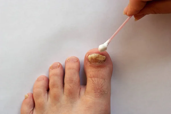 Cura Delle Unghie Dei Piedi Con Funghi Mano Femminile Con — Foto Stock