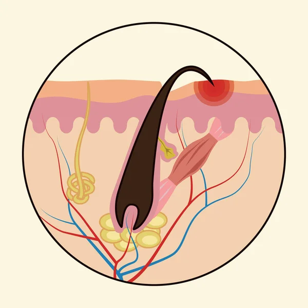 Ingegroeide Haren Medische Schema Van Haargroei Vector Illustratie Geïsoleerd Een — Stockvector