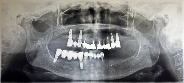 Orthopantomography of an adult patient,digital radiographic acquisition