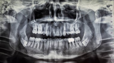 Orthopantomography of an adult patient,digital radiographic acquisition