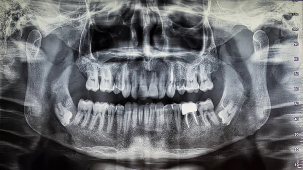 Ortoantomografia de um paciente adulto, aquisição radiográfica digital — Fotografia de Stock