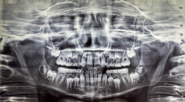 Orthopantomography of an adult patient,digital radiographic acquisition