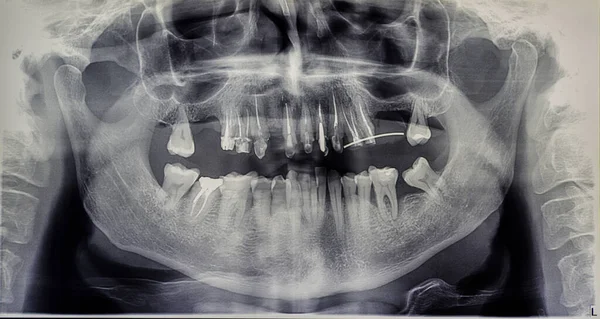 Orthopantomography of an adult patient,digital radiographic acquisition — Stockfoto