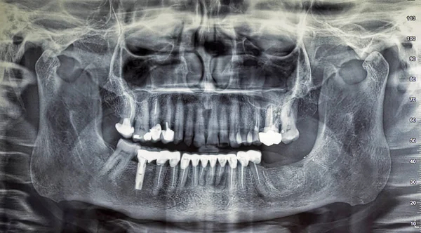 Orthopantomography of an adult patient,digital radiographic acquisition