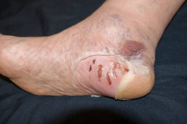 Chemical burn on the man's right foot.