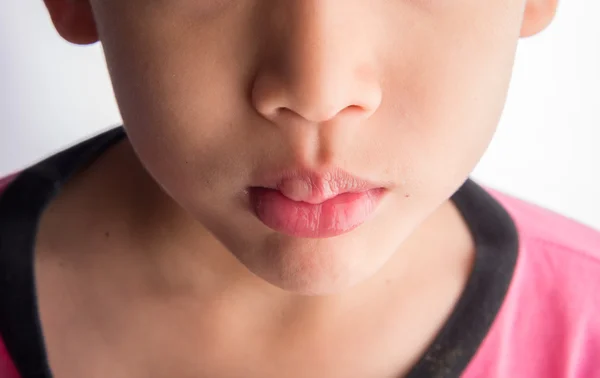 Allergic reaction on child mouth skin from food — Stock Photo, Image