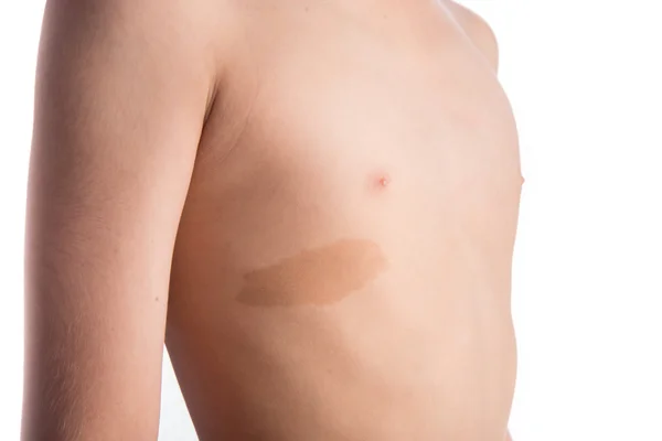 Detailní záběr pr dětský znamínko na prsou — Stock fotografie