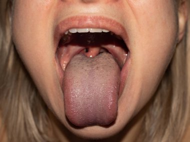 Boğazı ağrıyan hayal kırıklığına uğramış bir kadın. Ağzını aç ve kırmızı boğazı kapat.