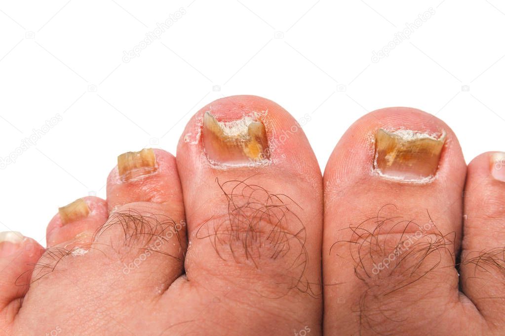 A toenail fungus