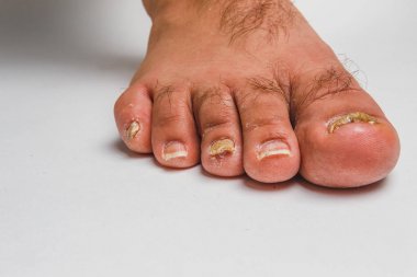 A toenail fungus clipart