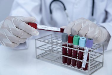 Doktor eli kan tüpü tutuyor ve kan testinin sonuçlarını kaydediyor..