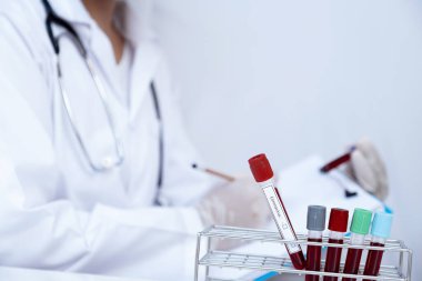 Doktor eli kan tüpü tutuyor ve kan testinin sonuçlarını kaydediyor..