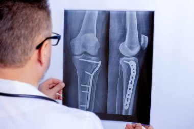 A male doctor examines an x-ray of the lower leg with a plate after surgery clipart