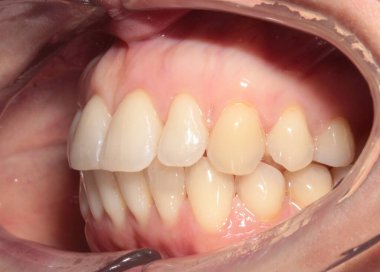 Diş telleriyle düzeltildikten sonra dişlerin yakın plan görüntüsü.