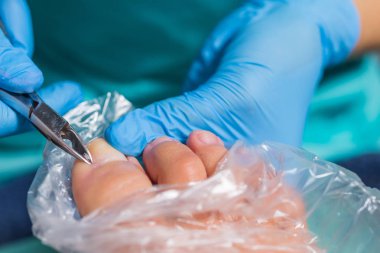 Pedikür süreci, manikür kaldırma