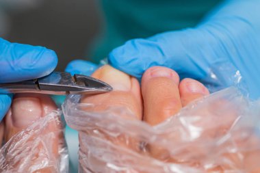 Pedikür süreci, manikür kaldırma