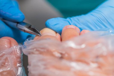 Pedikür süreci, manikür kaldırma