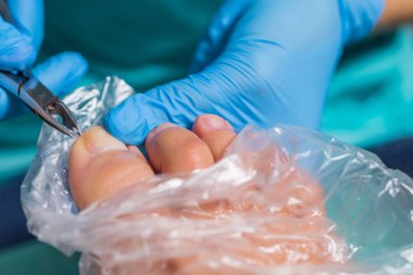 Pedikür süreci, manikür kaldırma