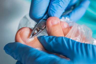 Pedikür süreci, manikür kaldırma