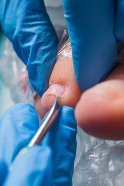 Pedikür portre. kütikül kaldırma