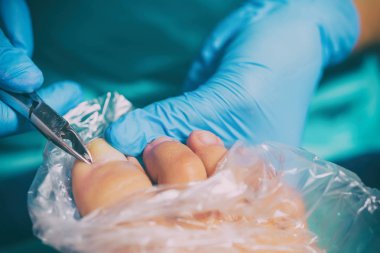 Pedikür sırasında peeling