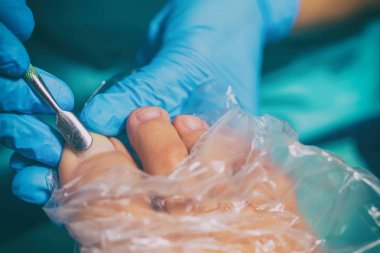 Pedikür sırasında peeling