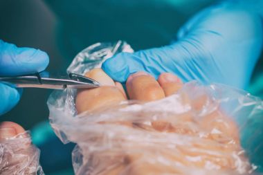 Pedikür sırasında peeling