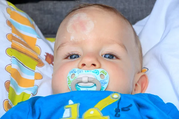 Nahaufnahme von Babyverletzungen. Der Gesichtsausdruck des Babys und die Narbe auf der Stirn, nachdem er seinen Kopf auf den Boden geschlagen hat. — Stockfoto