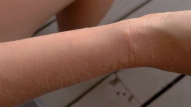 Kedi ile oynadıktan sonra kadın koluna alerjik reaksiyon.
