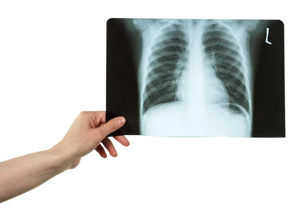 Weibliche Hand mit schwarz-weißem Röntgenbild der Brust isoliert — Stockfoto