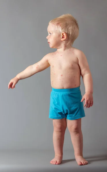 Auf dem Körper eines kleinen Jungen Ausschlag von Windpocken, auf grau — Stockfoto