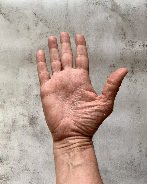 Tiro Vertical Uma Mão Com Uma Pele Rachada Seca — Fotografia de Stock