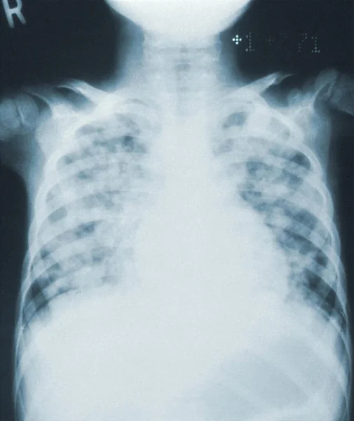 Röntgenbild Bröstet Och Halsen Person — Stockfoto
