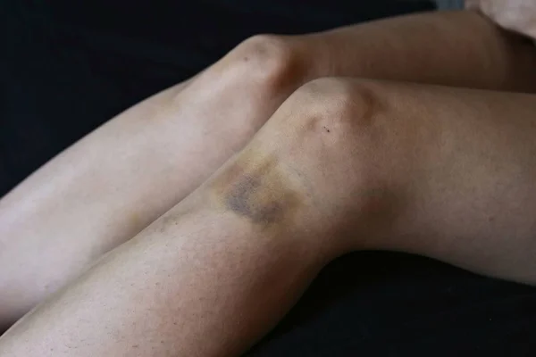 Grande Hematoma Perna Uma Mulher Violência Contra Imagem Conceitual Das — Fotografia de Stock