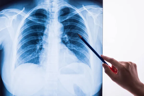 siyah beyaz X-ray görüntü için tıbbi bir diagn bir insan göğüs