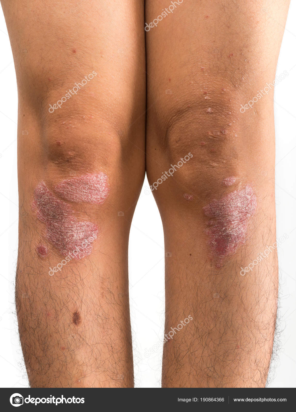 plakkos psoriasis fotók s kezels