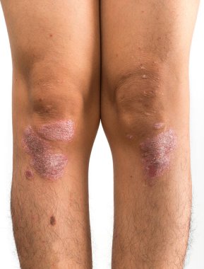 Psoriasis that knee on white background clipart