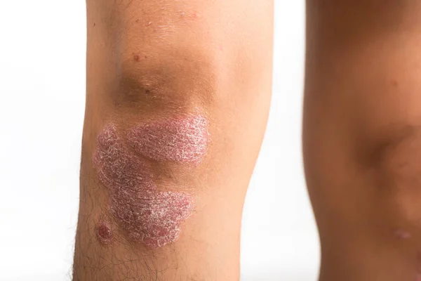 Psoriasis som knä på vit bakgrund — Stockfoto