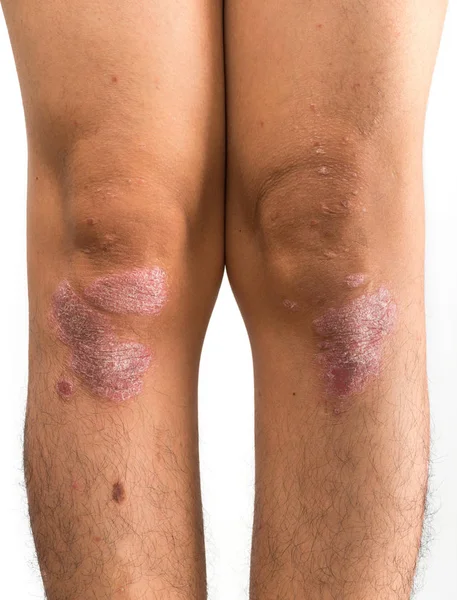 Psoriasis die knie op witte achtergrond — Stockfoto