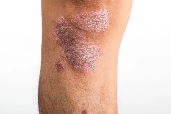 Psoriasis som knä på vit bakgrund — Stockfoto