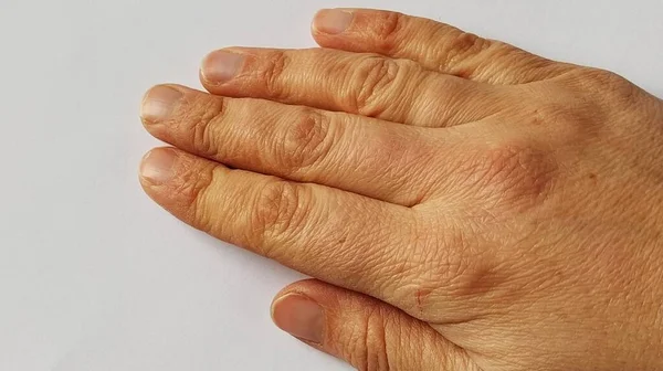 Primer plano de la piel en el cepillo de una mujer blanca. En la piel seca, se notan numerosas arrugas finas y poros. Es necesaria la consulta de un dermatólogo o cosmetólogo. Deshidratación. Uñas malas — Foto de Stock