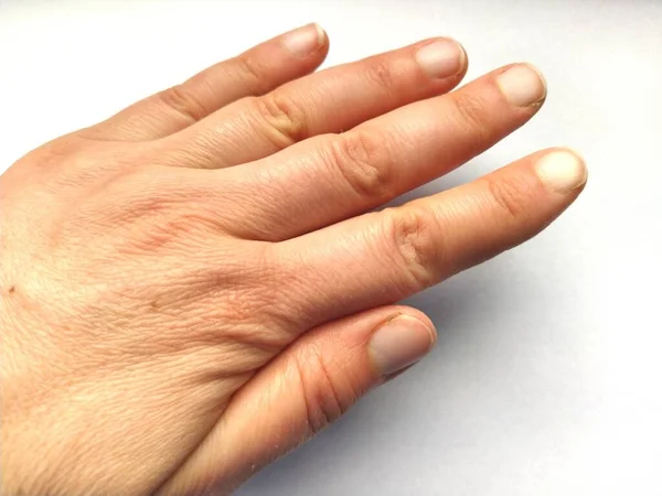 Mano Femminile Con Pelle Atopica Secca Sfondo Bianco Primo Piano — Foto Stock