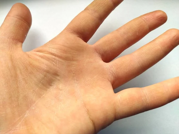 乾燥したアトピー性皮膚を持つ女性の手 白地だ 手のひらと指の上の皮膚のクローズアップ ケアと水分補給を必要とする皮膚 ヤシの木のしわ — ストック写真