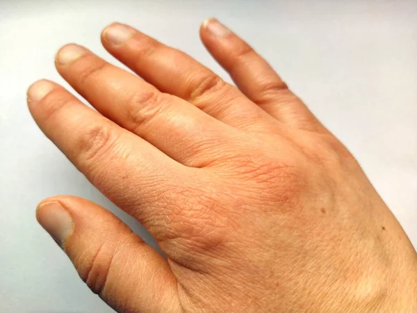 Mano Femminile Con Pelle Atopica Secca Articolazioni Doloranti Sfondo Bianco — Foto Stock