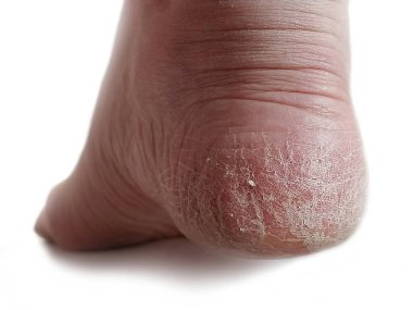 Kadın bacağının topuğunda onikositoz ve kuru deri var. Candida mantarı kaşıntıya, çatlaklara, kızarıklığa ve deri parçacıklarının dökülmesine neden oldu. Üst derinin yapısı yakından inceleniyor. Beyaz arka plan. Dermatolojik sorunlar